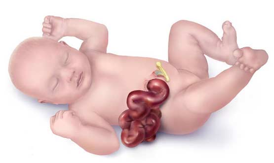 More babies are being born with organs outside their bodies; experts stumped




